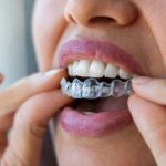 How Invisalign Aligners Reduce Orthodontic Relapse Rates Through Advanced Retention Planning