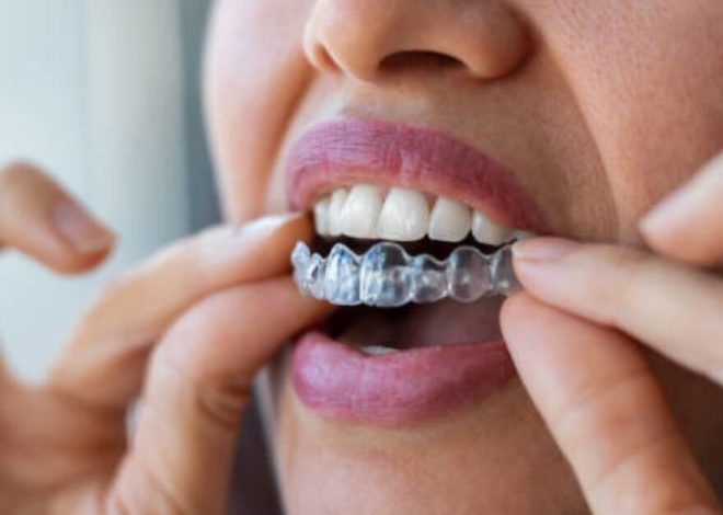 How Invisalign Aligners Reduce Orthodontic Relapse Rates Through Advanced Retention Planning