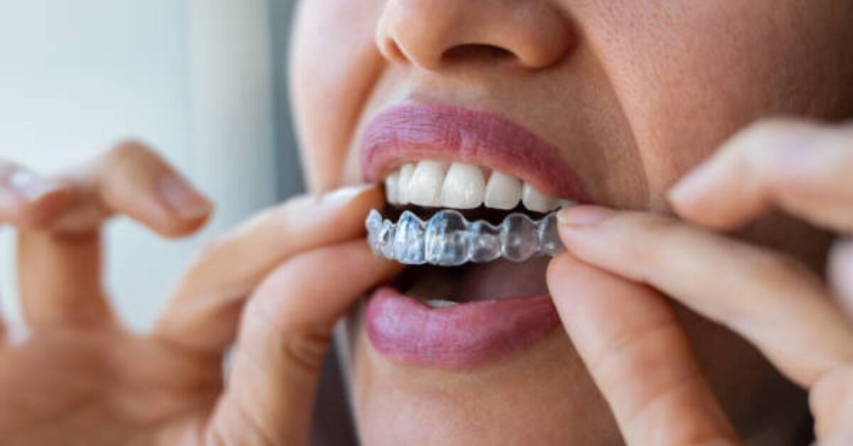 How Invisalign Aligners Reduce Orthodontic Relapse Rates Through Advanced Retention Planning